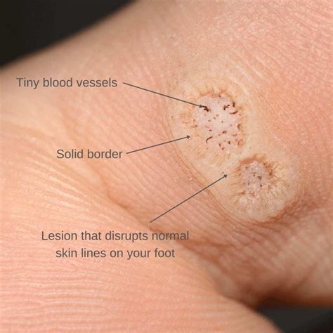 But some experts recommend immediate treatment to reduce the amount of virus shed into nearby tissue and possibly lower the risk of recurrence. . Stages of a plantar wart falling off